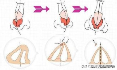 ​歪鼻整形的方法有哪些（歪鼻整形手术方法有哪些）